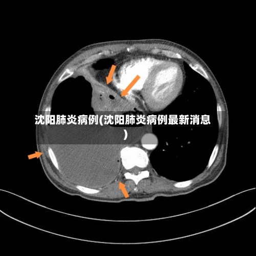 沈阳肺炎病例(沈阳肺炎病例最新消息)