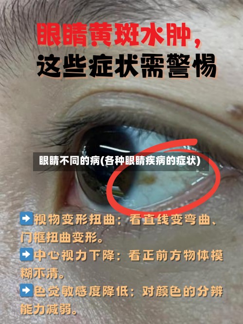 眼睛不同的病(各种眼睛疾病的症状)